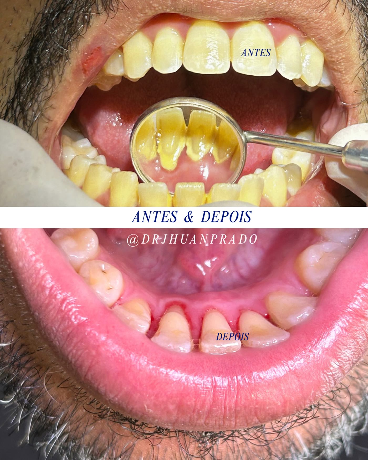 Antes e depois de tratamento odontológico inferior
