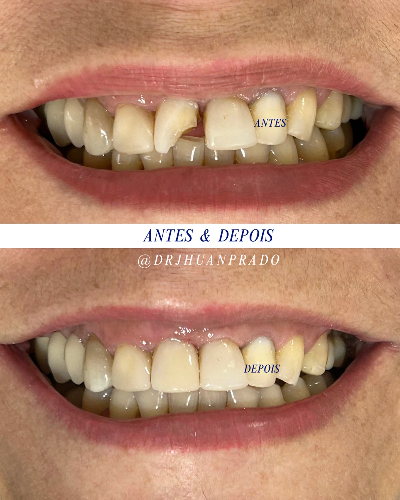 Antes e depois de reconstrução dos dentes anteriores